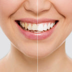 Smile White™ — El Lápiz Blanqueador 4X Más Potente (Promo 2x1)
